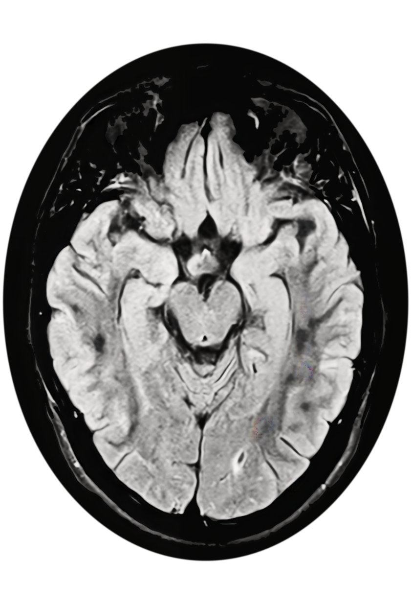 An MRI image of a brain in black and white.