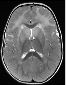 MRI image of a brain with signal abnormality and swelling of the basal ganglia and thalami.