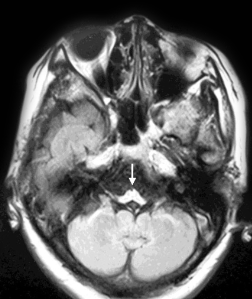 MRI image of severe atrophy of the medulla oblongata.