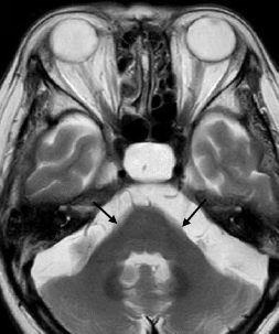 MRI image of atrophy of the cerebellum and middle cerebellar peduncles.