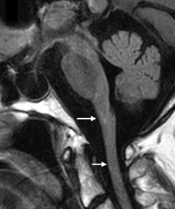 MRI image of mild atrophy of the medulla oblongata and upper cervical cord with preservation of the pons.