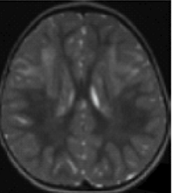MRI image of a brain’s periventricular rim of low signal intensity on T2-weighted images and high signal intensity on T1-weighted images.