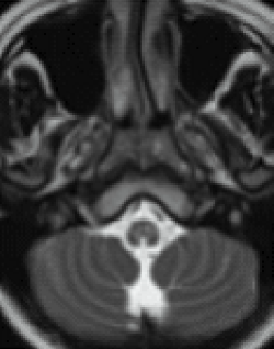 MRI image of a brain with areas of signal abnormality in the posterior part of the midbrain and central part of the medulla.