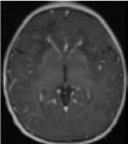 A contrast enhancement MRI image of a brain involving ventricular lining, periventricular rim, frontal white matter, optic chiasm, fornix, basal ganglia, or thalami.