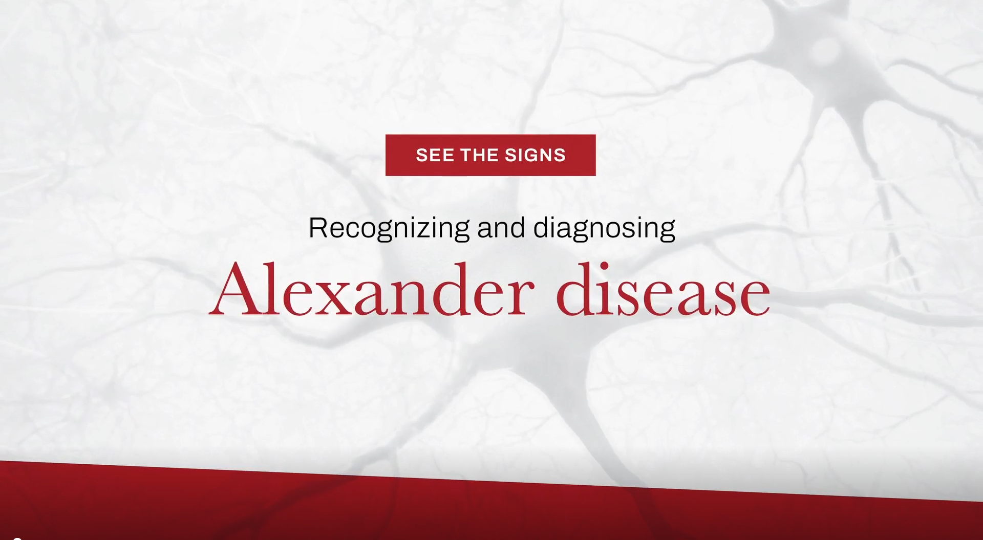 Alexander disease