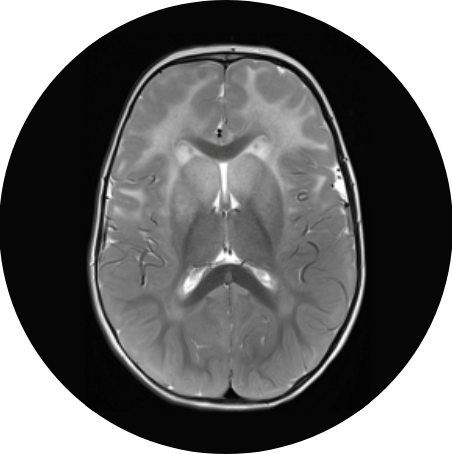 MRI image of a brain.