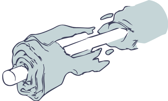 An illustration of healthy myelin on the left and damaged myelin on the right. [78]
